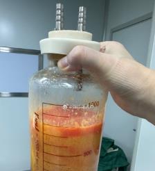 嘉兴水动力吸脂手术要做多久？